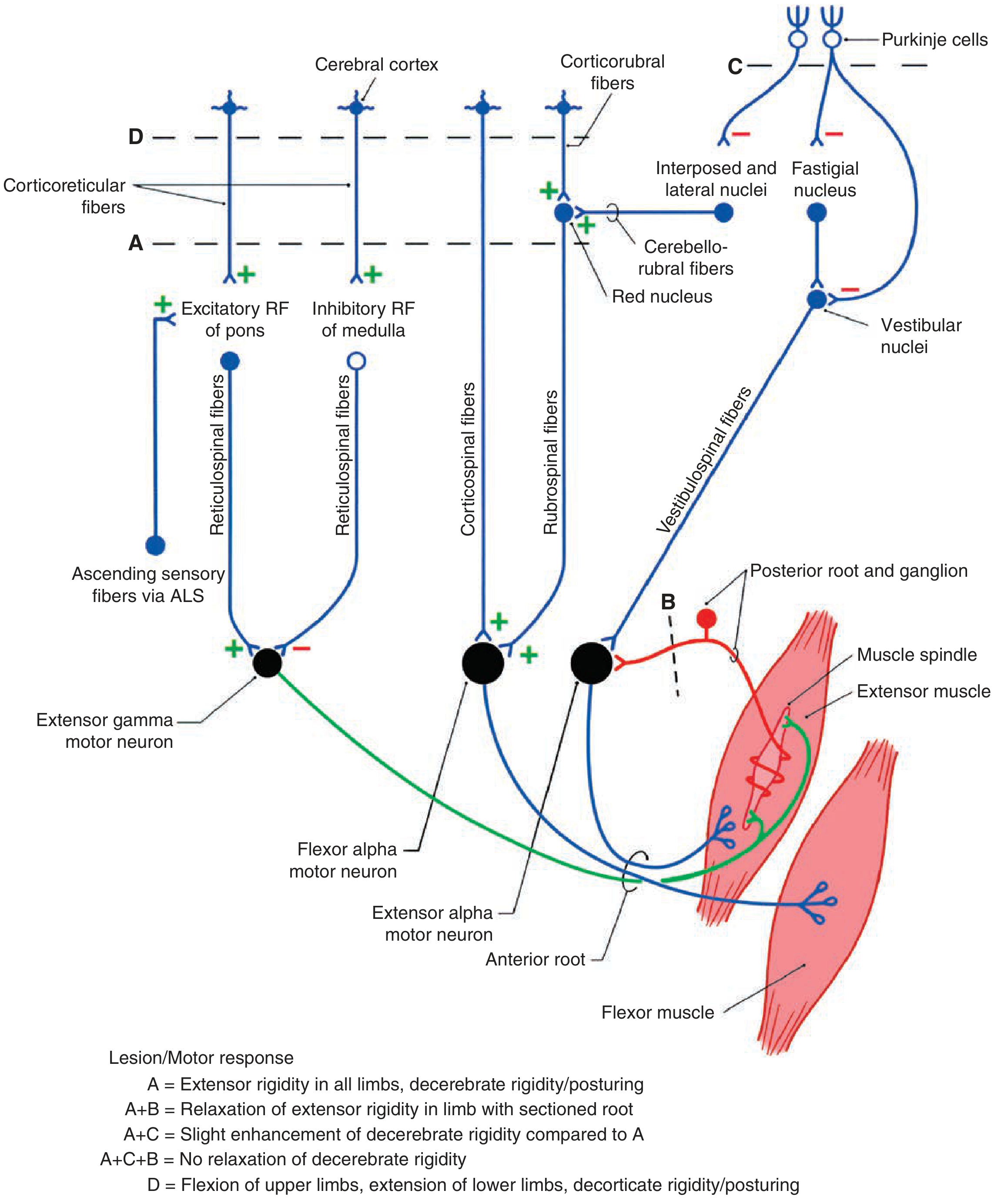 Ganong circuit diagram of decerebrate and decorticate rigidity - lesion A = intercollicular decerebration causing extensor rigidity via gamma loop