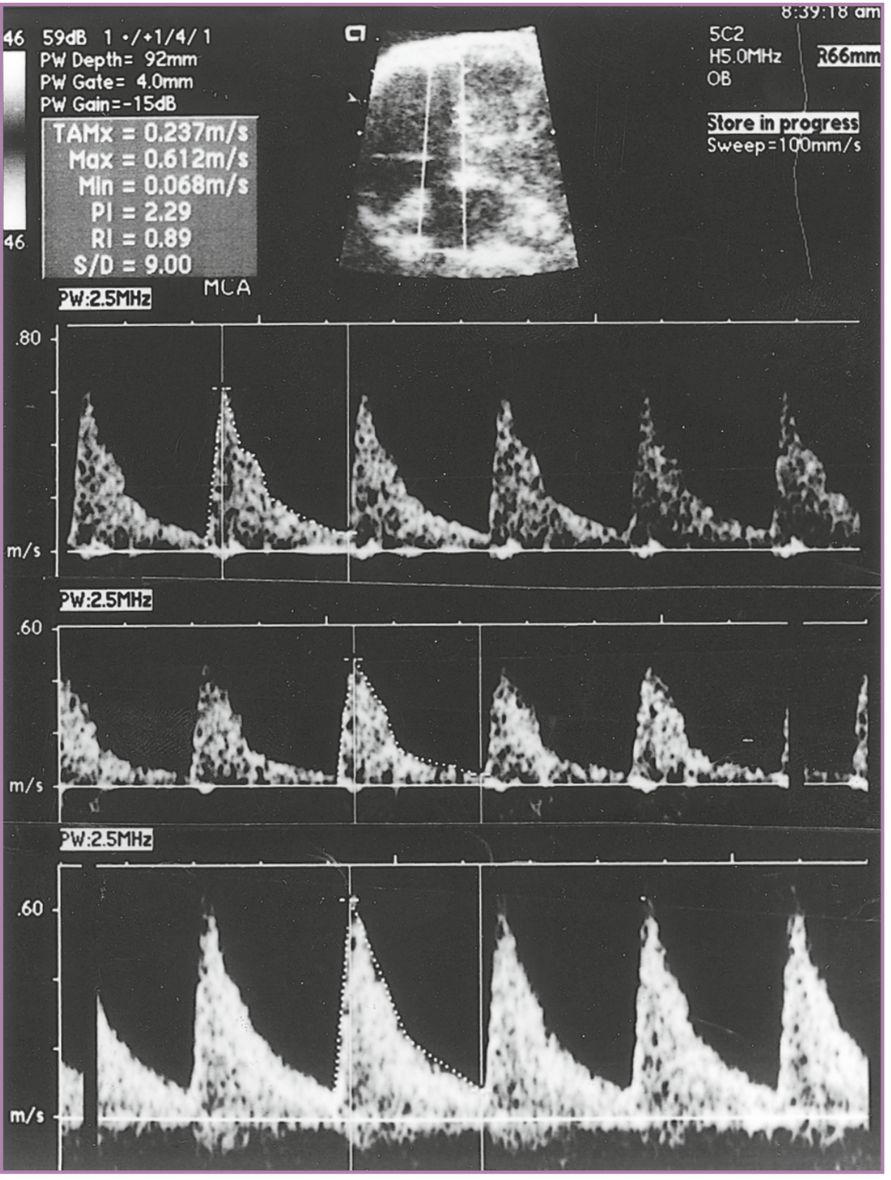 MCA Doppler PSV serial measurements in fetal anemia