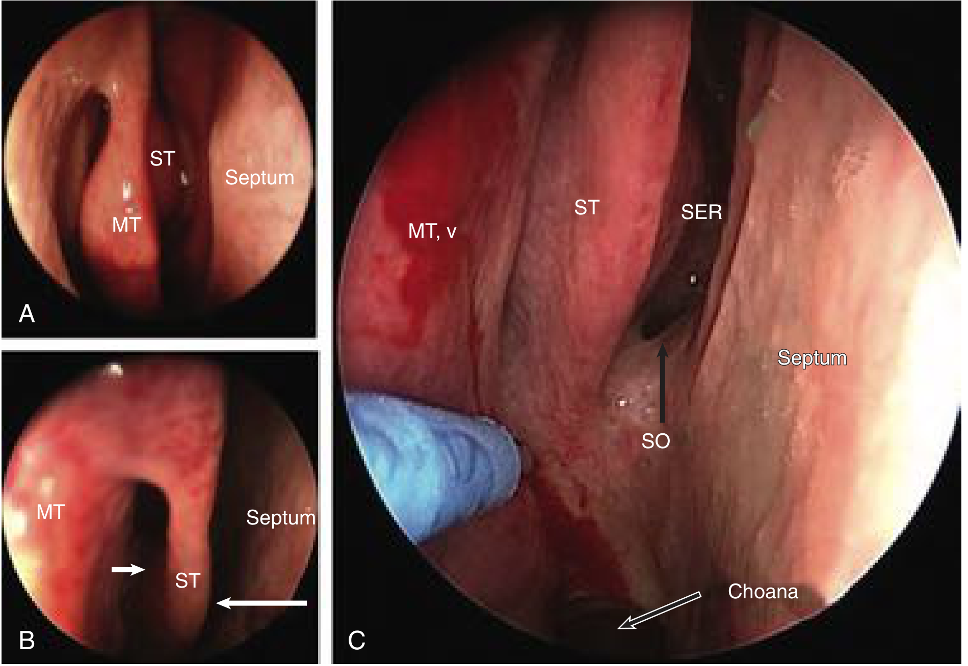 Endoscopic views A-C showing superior turbinate (ST), middle turbinate (MT), superior meatus (arrow), sphenoethmoidal recess (SER), sphenoid ostium (SO), and choana from progressively posterior viewpoints