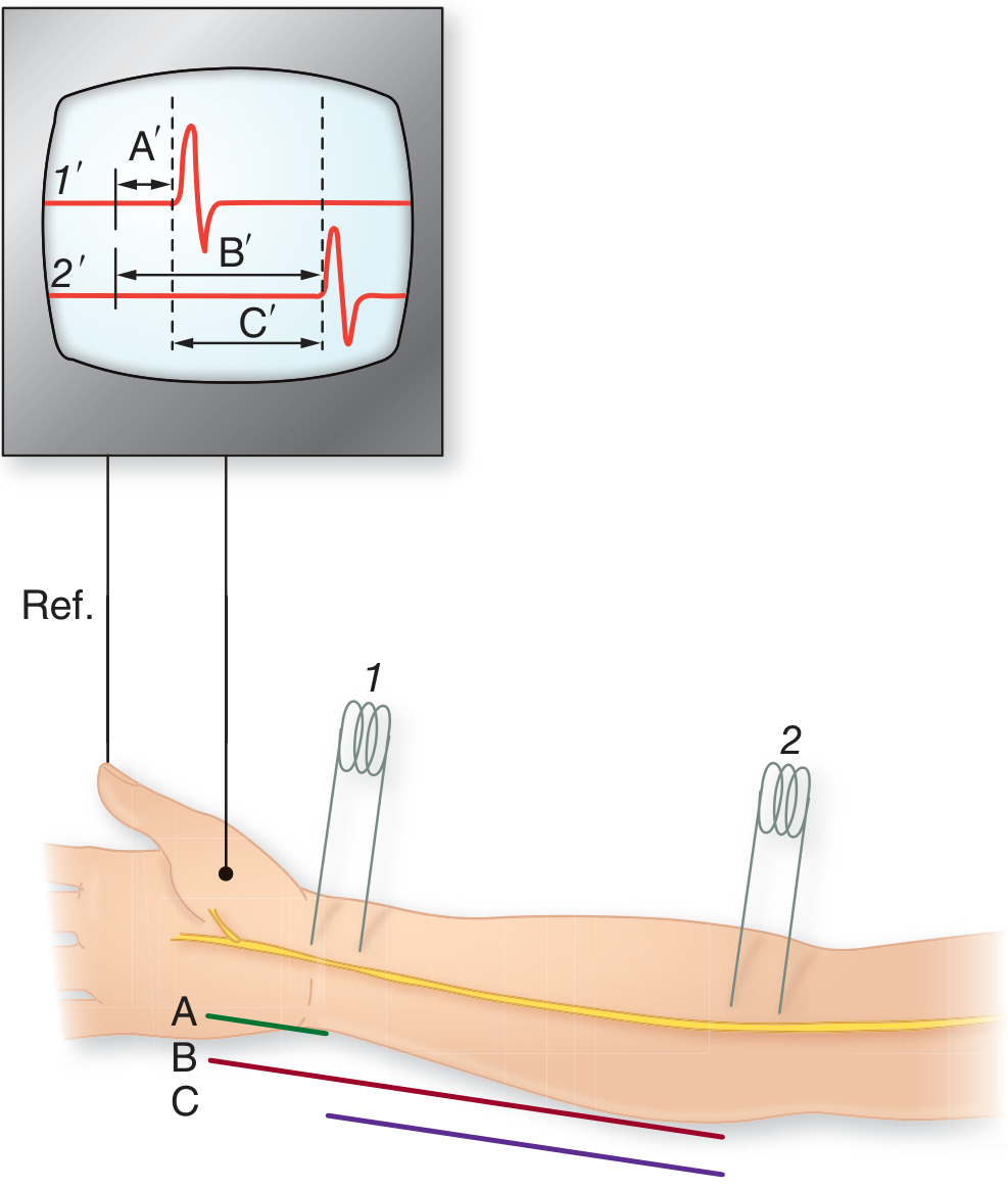 Median nerve motor NCS setup showing wrist (site 1) and elbow (site 2) stimulation with CMAP recorded over abductor pollicis brevis (APB). A' = distal latency; B' = proximal latency; MCV = distance C / (B' - A')