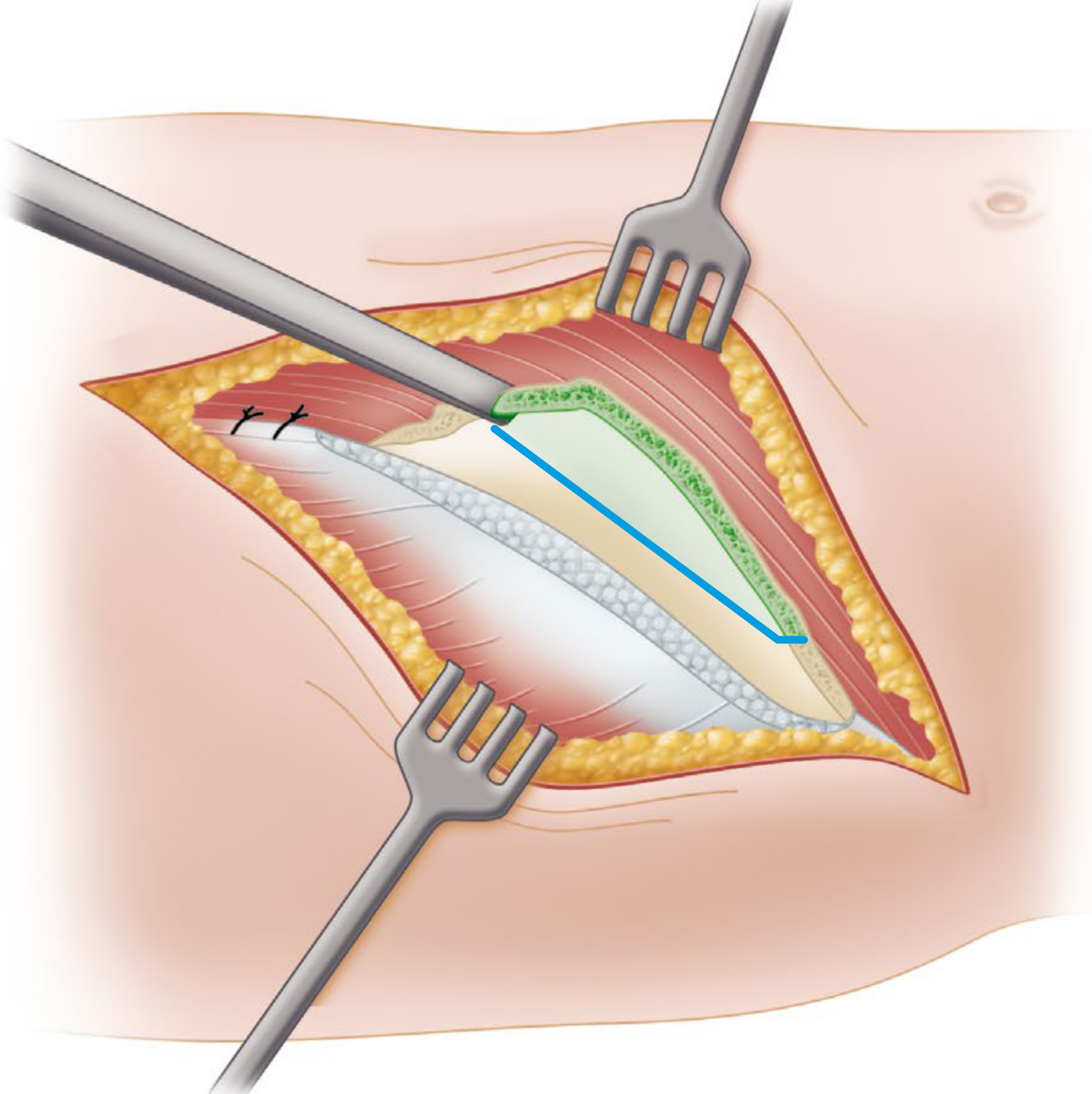 Staged release with incision line marked in blue showing extent of IT band division