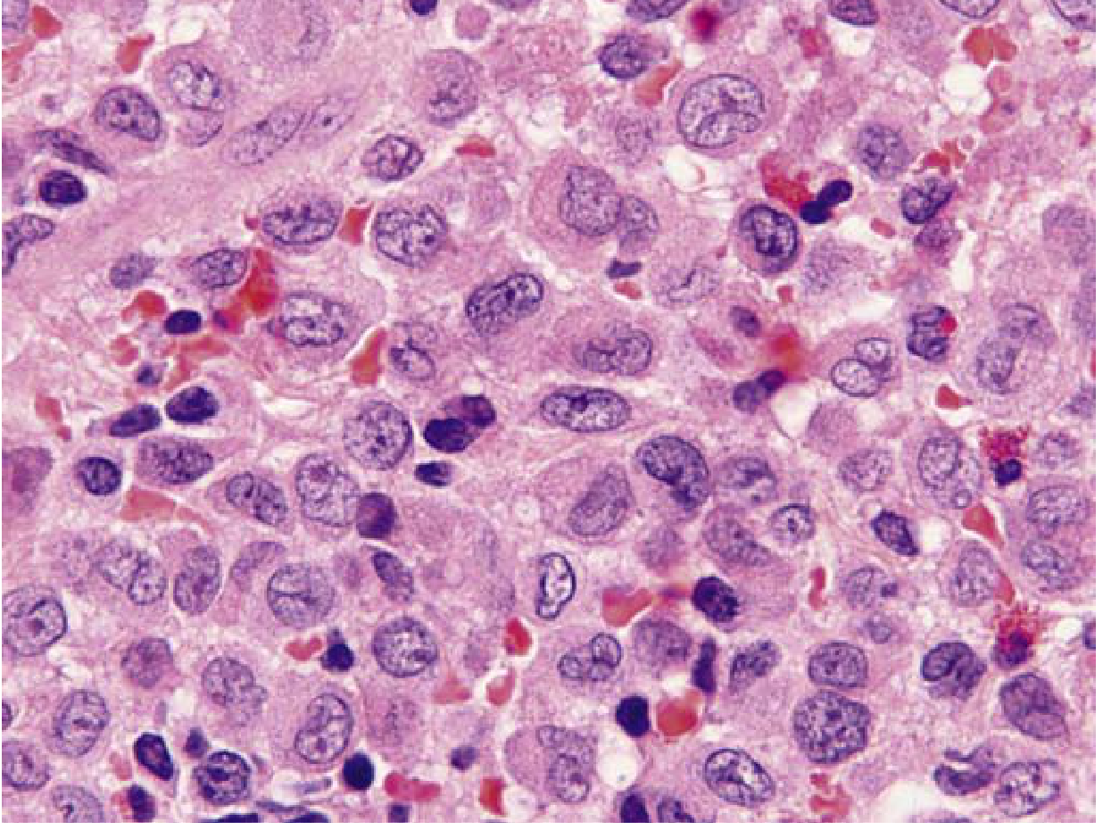 LCH histology (Robbins): folded/grooved nuclear contours, abundant pink cytoplasm