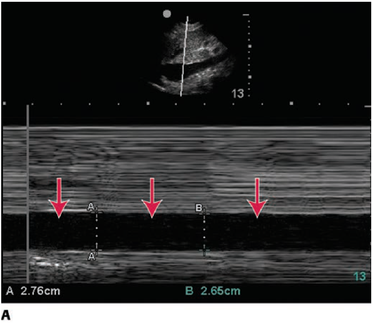 IVC dilated - volume overload