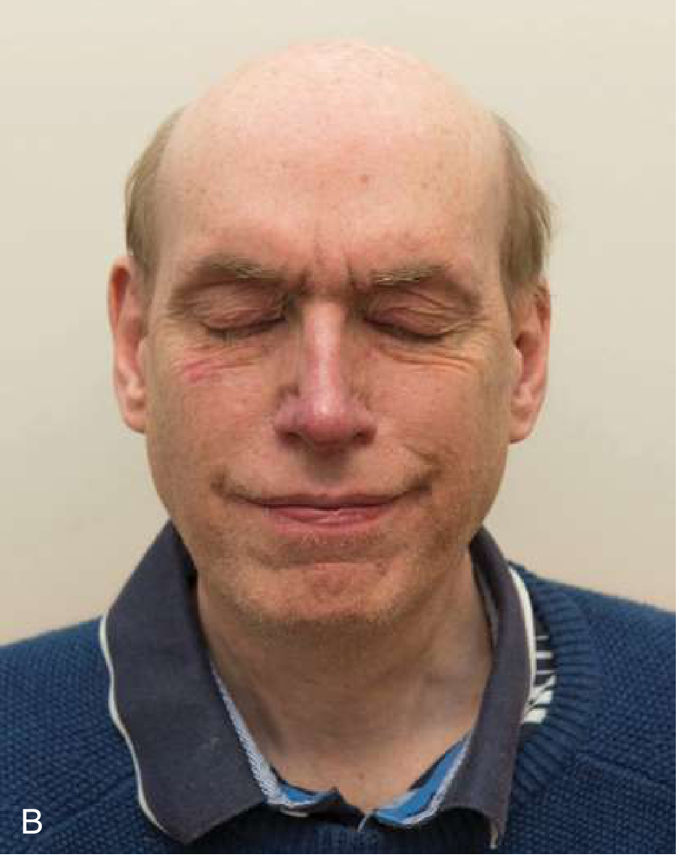 Myotonic dystrophy type 1 - orbicularis oculi weakness on forced eye closure (Panel B)