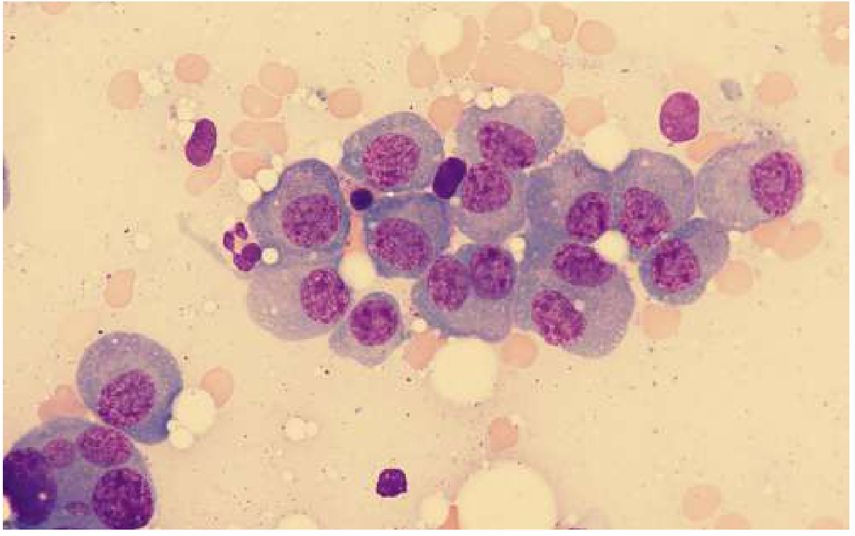 Bone marrow aspirate showing clonal plasma cells in multiple myeloma with eccentric nuclei and perinuclear hof