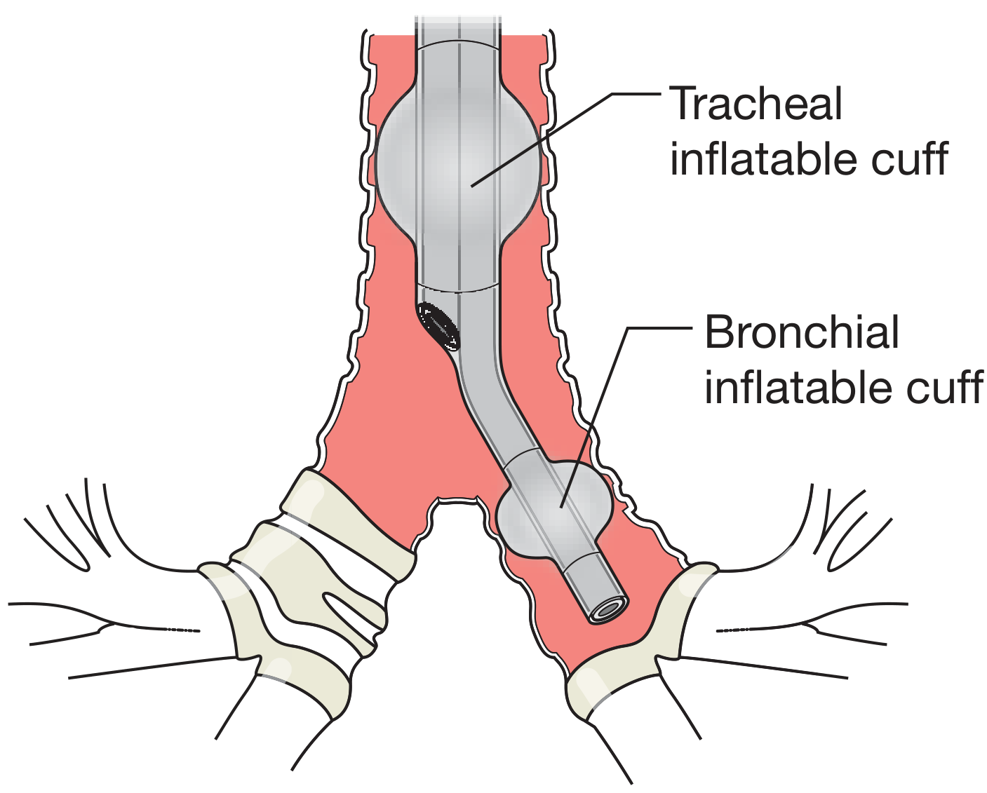 Double-lumen tube with tracheal and bronchial inflatable cuffs for one-lung ventilation
