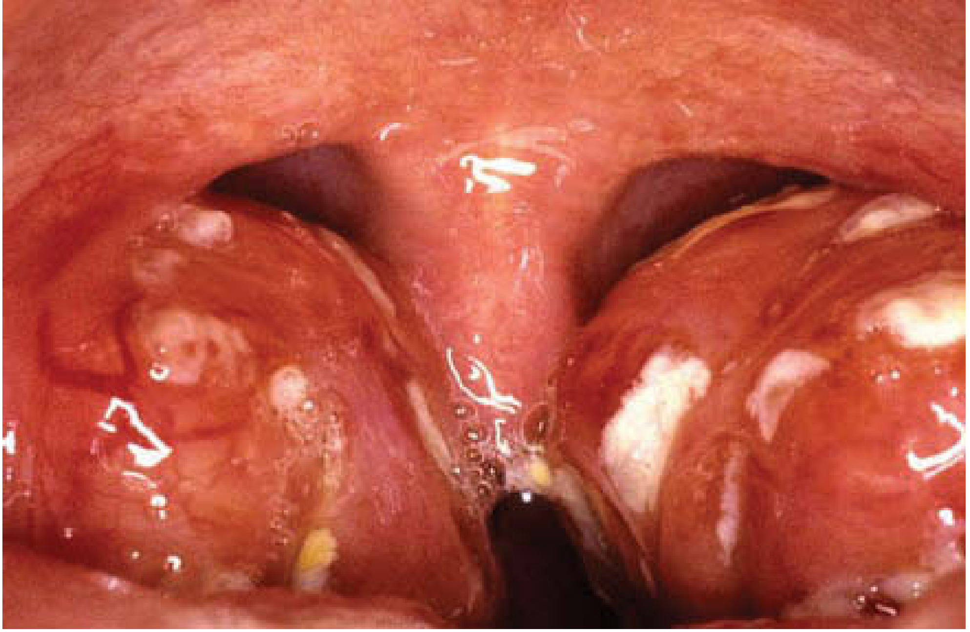 Bacterial tonsillitis with white exudate and red inflamed tissue