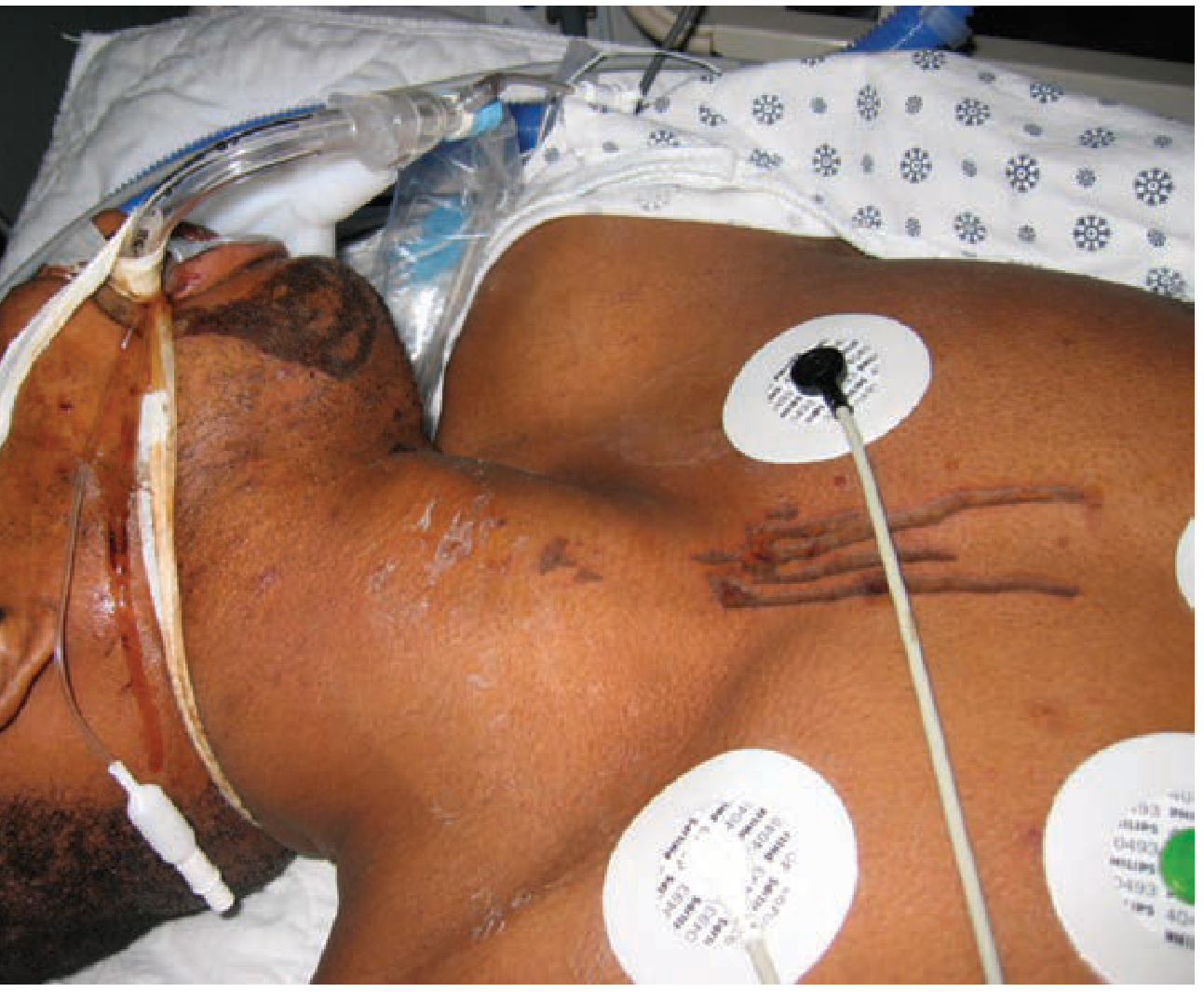 Acid ingestion — dermal dribble burns on upper chest