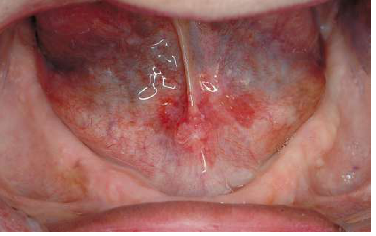 Erythroplakia of anterior mouth floor - biopsy proven squamous cell carcinoma