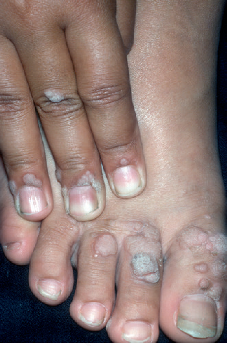 Warts on fingers and toes showing periungual and dorsal involvement