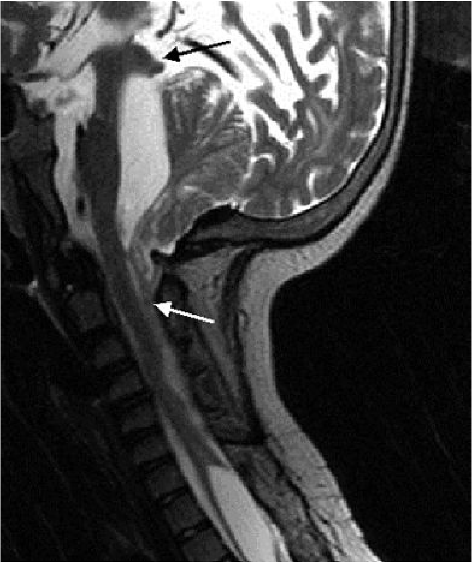 Sagittal MRI showing Chiari II malformation - cerebellar tissue and brainstem herniate downward through foramen magnum into the cervical spine (white arrow), with cerebellum towering superiorly (black arrow)