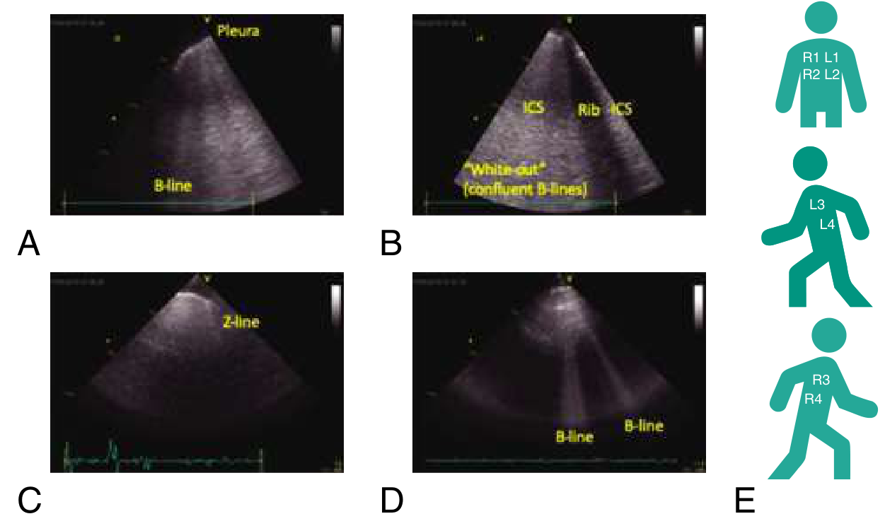 8-point LUS for AHF - B-lines before treatment (top) vs. after treatment (bottom)