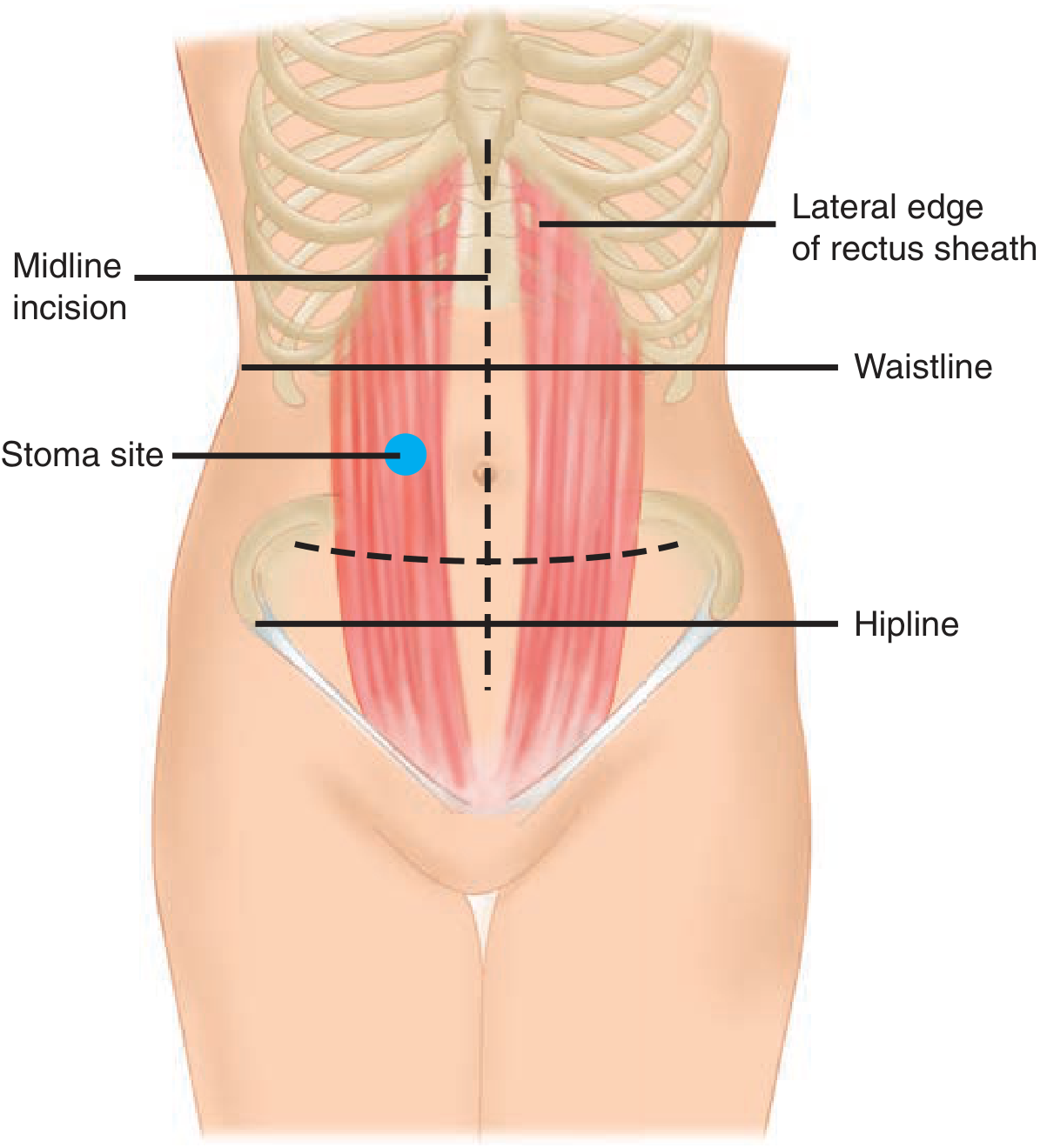 Ideal stoma siting: within the rectus abdominis, below the waistline, above the hipline, visible to the patient, away from scars/bony prominences - Schwartz's Principles of Surgery