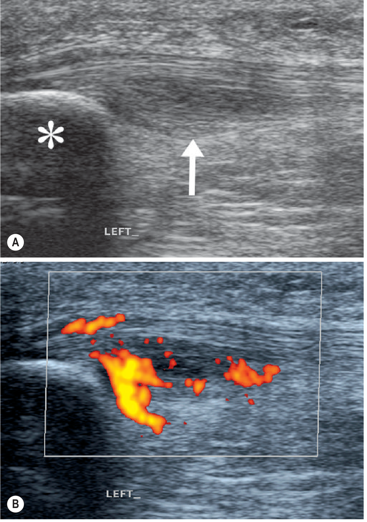 Jumper's Knee ultrasound showing thickening and neovascularisation