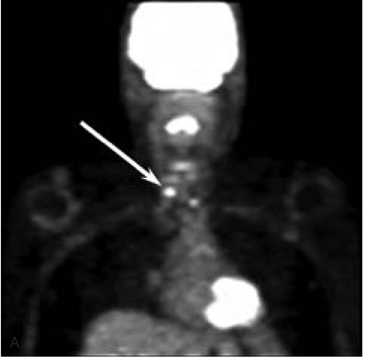 Coronal PET greyscale showing neck uptake