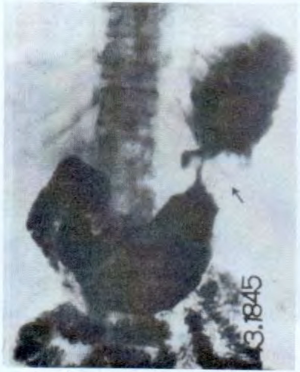 Gastric carcinoma causing hour-glass contracture (arrow)
