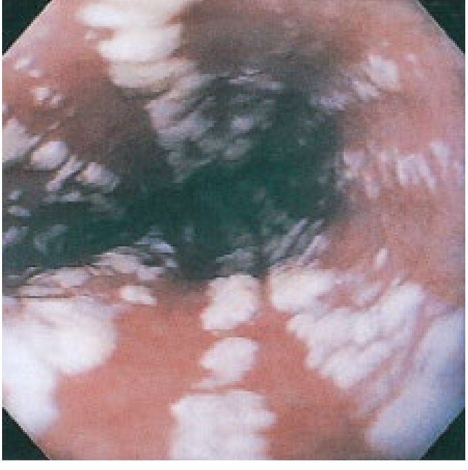 Endoscopy showing multiple white raised plaques on the esophageal mucosa with normal intervening mucosa - Candida esophagitis