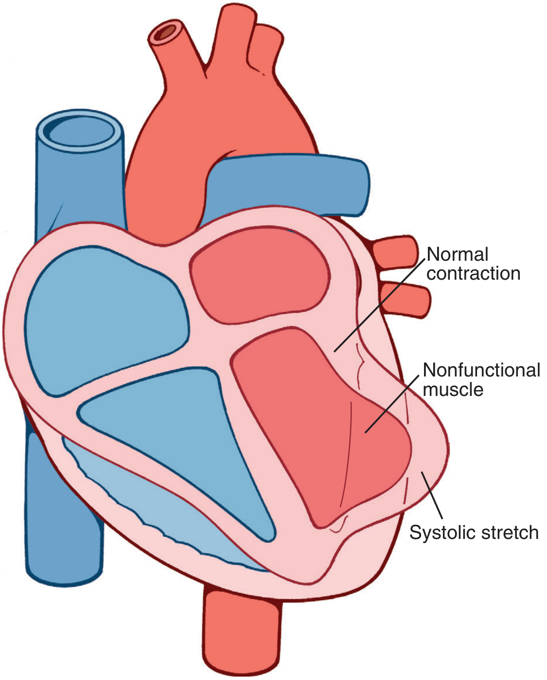Systolic stretch in an area of ischemic cardiac muscle showing normal contraction vs nonfunctional bulging
