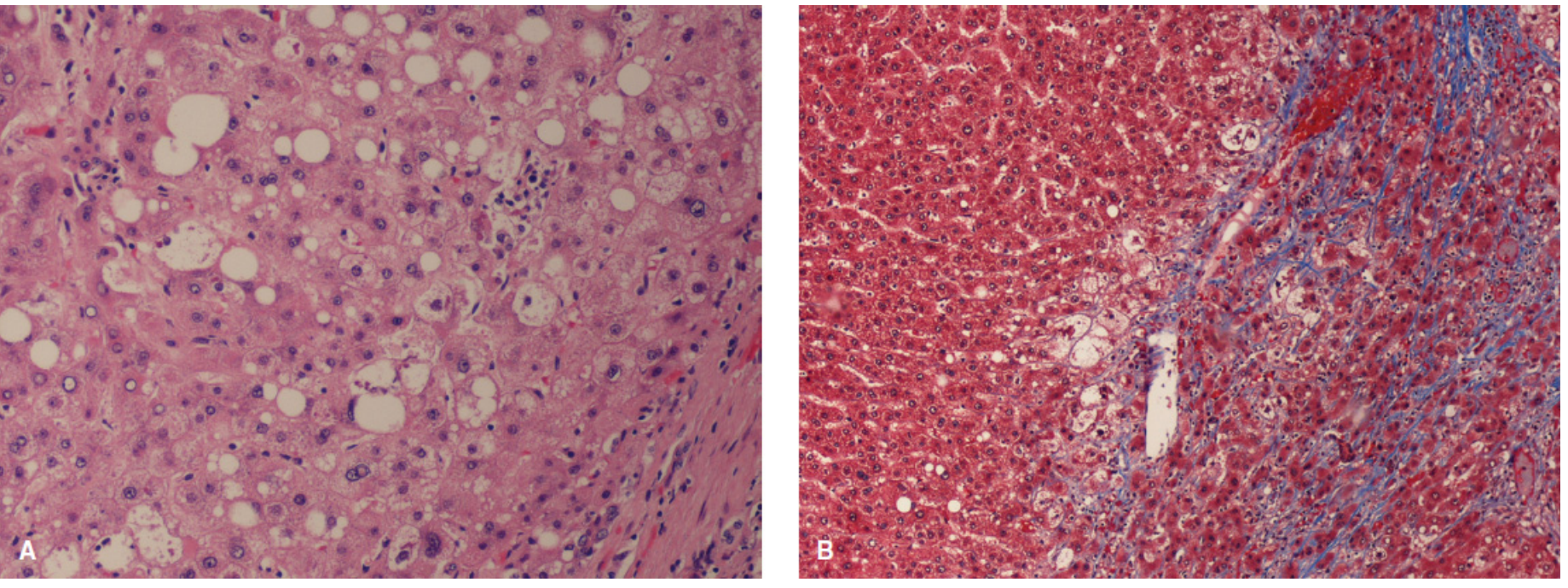 A: Steatohepatitis (H&E, 20x) - macrosteatosis, inflammatory infiltrate, and Mallory-Denk bodies. B: Trichrome stain - steatohepatitis with established fibrosis (blue collagen). Courtesy Johns Hopkins — Mulholland & Greenfield's Surgery, 7e