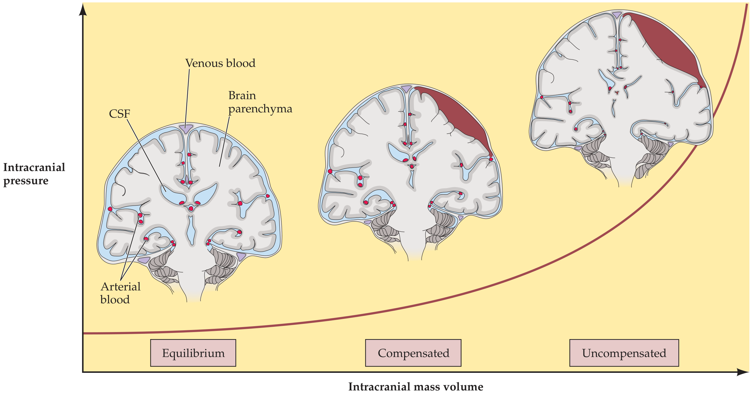 ICP vs Intracranial Mass Volume - showing equilibrium, compensated, and uncompensated phases
