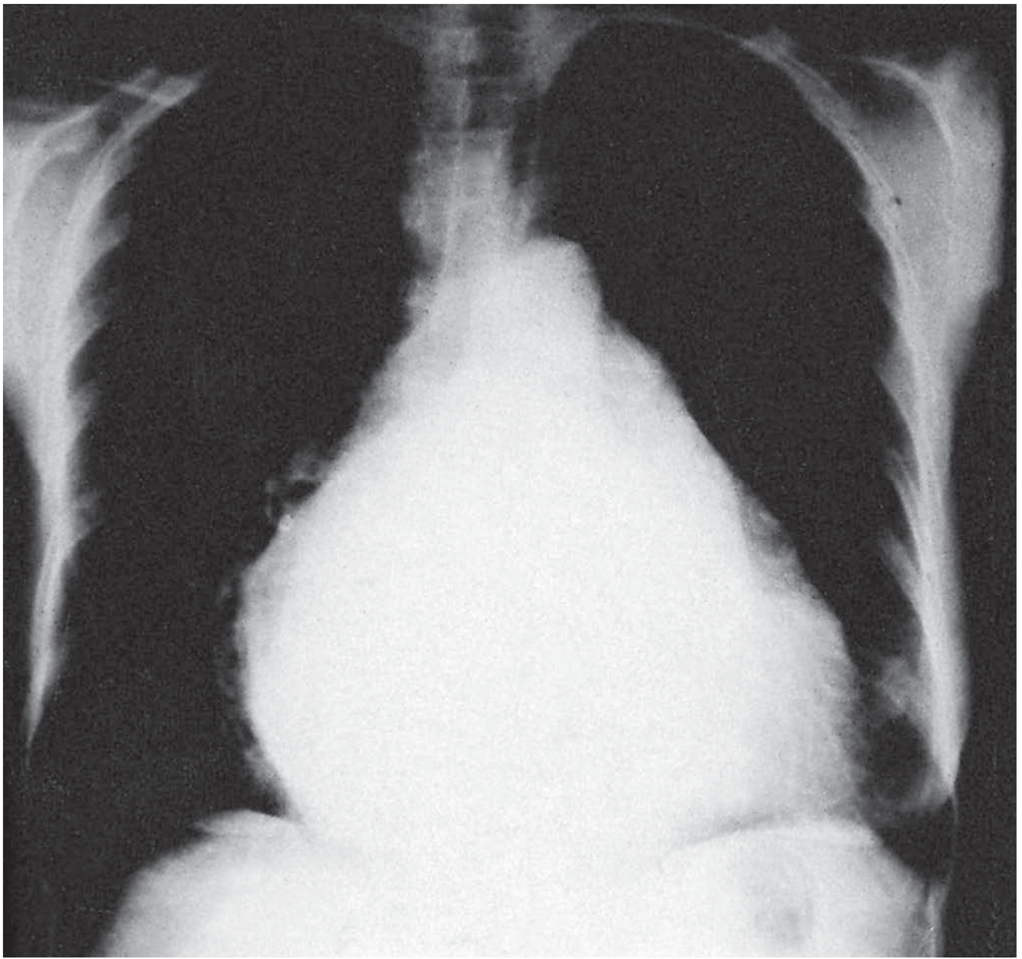 Chest radiograph of longstanding mitral stenosis showing a massive left atrium