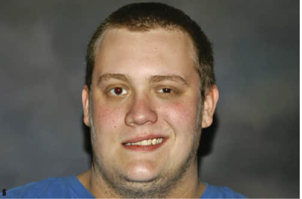 Right Facial Palsy - LMN