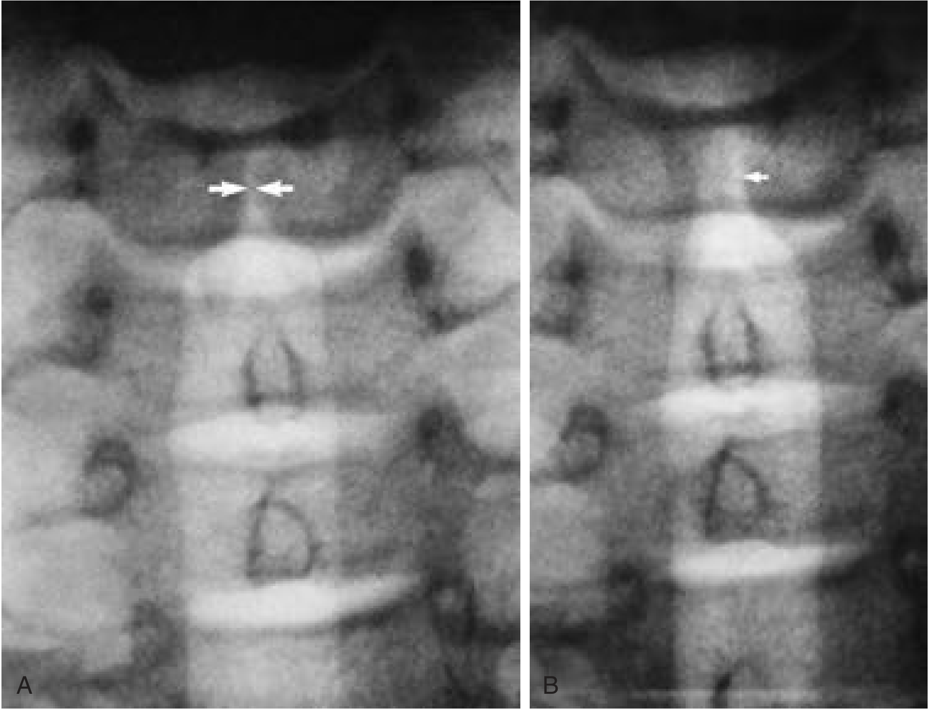 Left true vocal cord paralysis - CT imaging showing paramedian cord position during phonation (A) and during inspiration showing left cord fixation with right cord abducting normally (B)