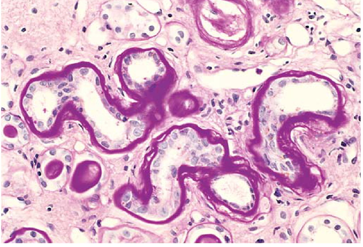 PAS stain: Tubular BM thickening in diabetic nephropathy