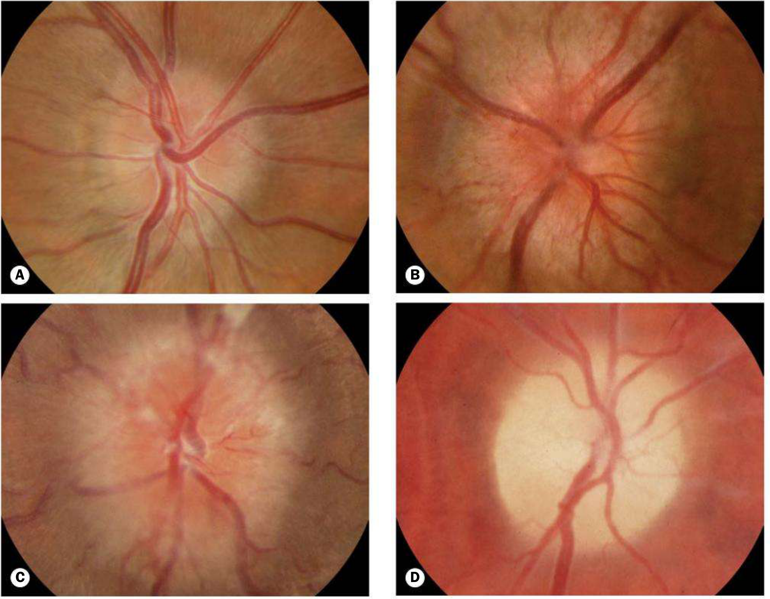 Papilloedema - all 4 stages: Early, Acute Established, Chronic, Atrophic