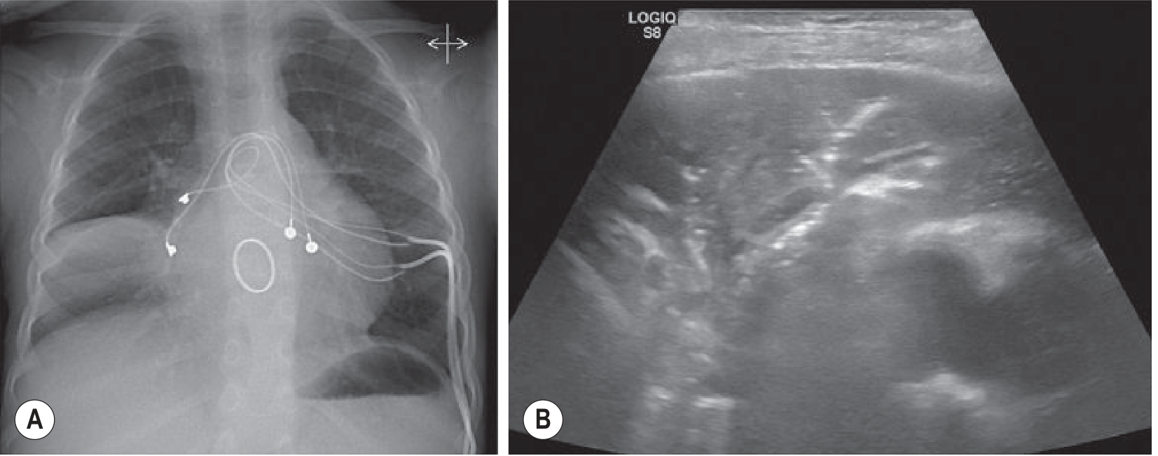Consolidation: CXR right lung base opacity (A) and corresponding ultrasound with air bronchograms (B)