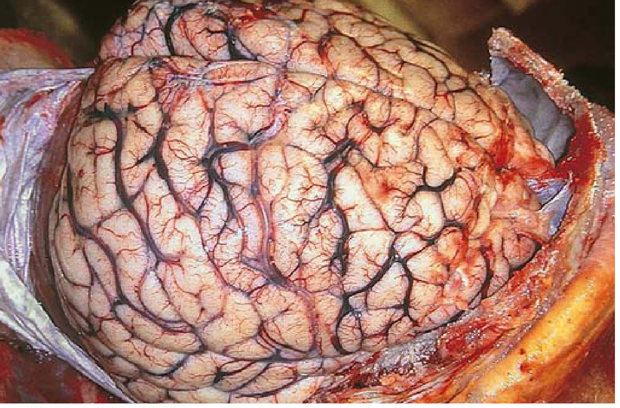 Cerebral edema: brain with flattened gyri pressed against skull from swelling