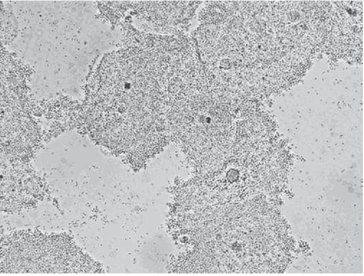 Wet mount showing clue cells in bacterial vaginosis - note obscured epithelial cell margins and granular appearance from adherent bacteria (x400)