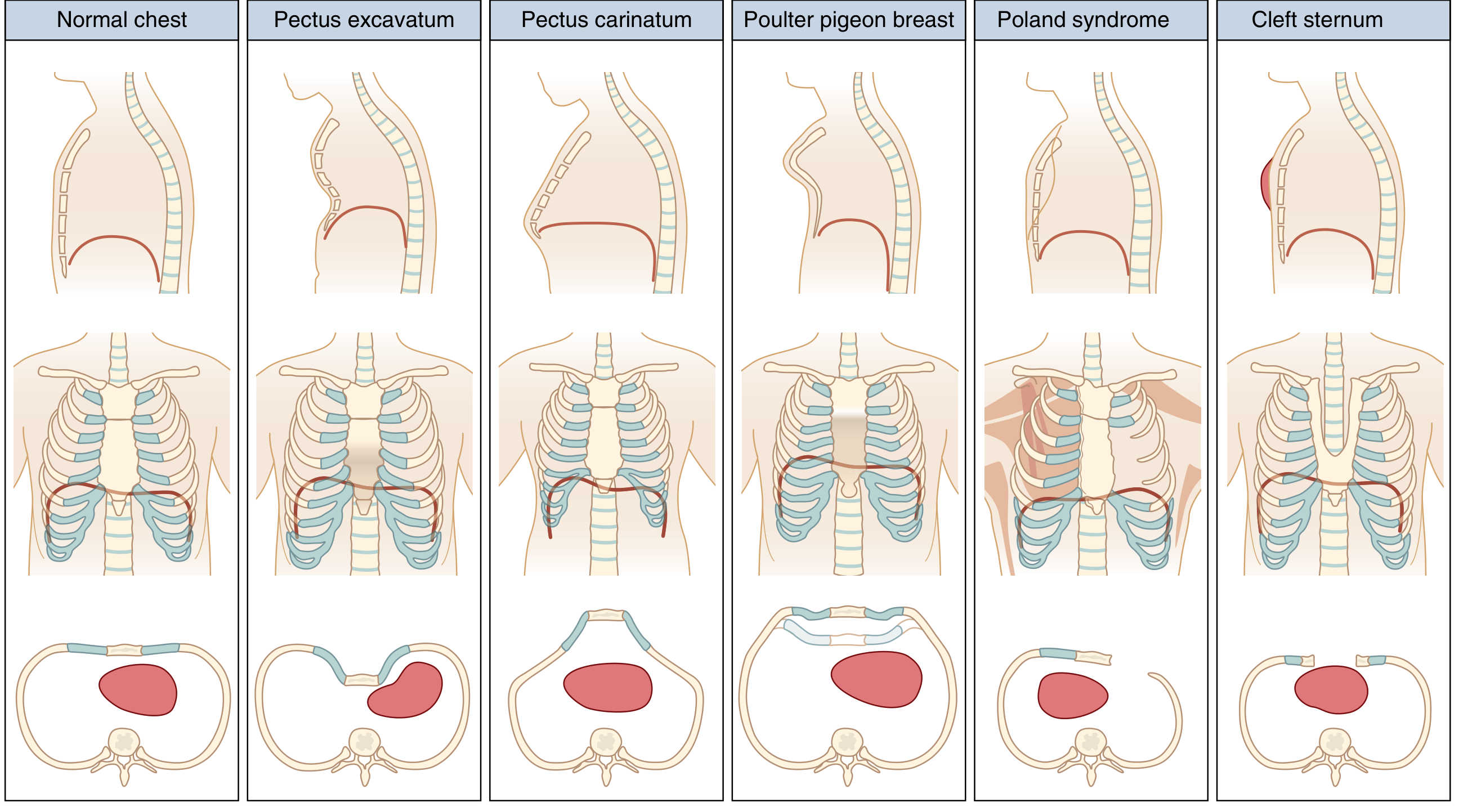 Classification of chest wall deformities - normal, pectus excavatum, pectus carinatum, pouter pigeon breast, Poland syndrome, cleft sternum
