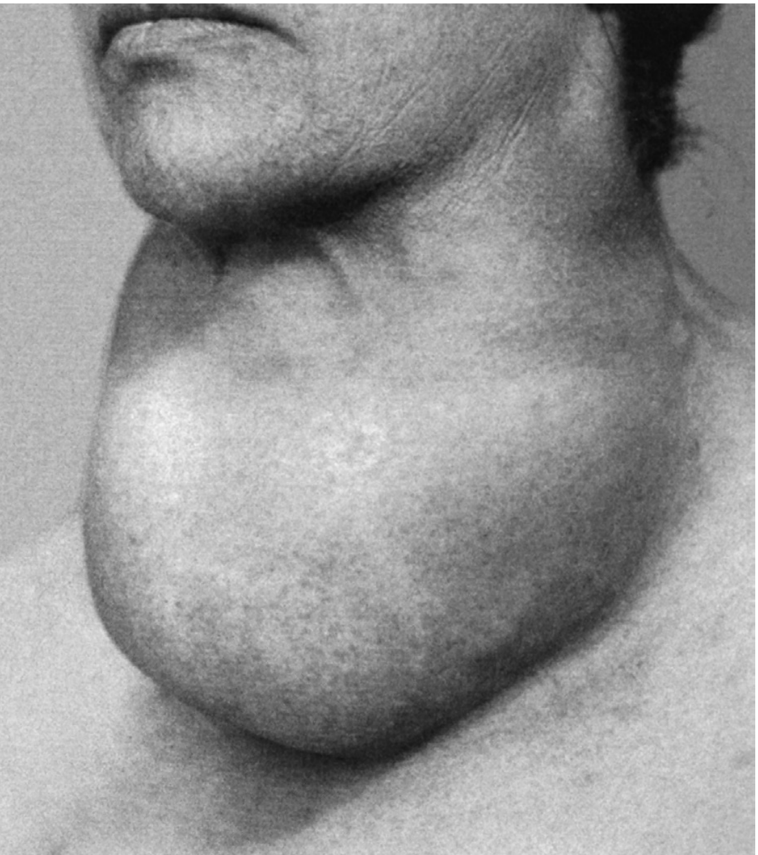 Huge colloid goitre in a 52-year-old female with compressive symptoms - Robbins