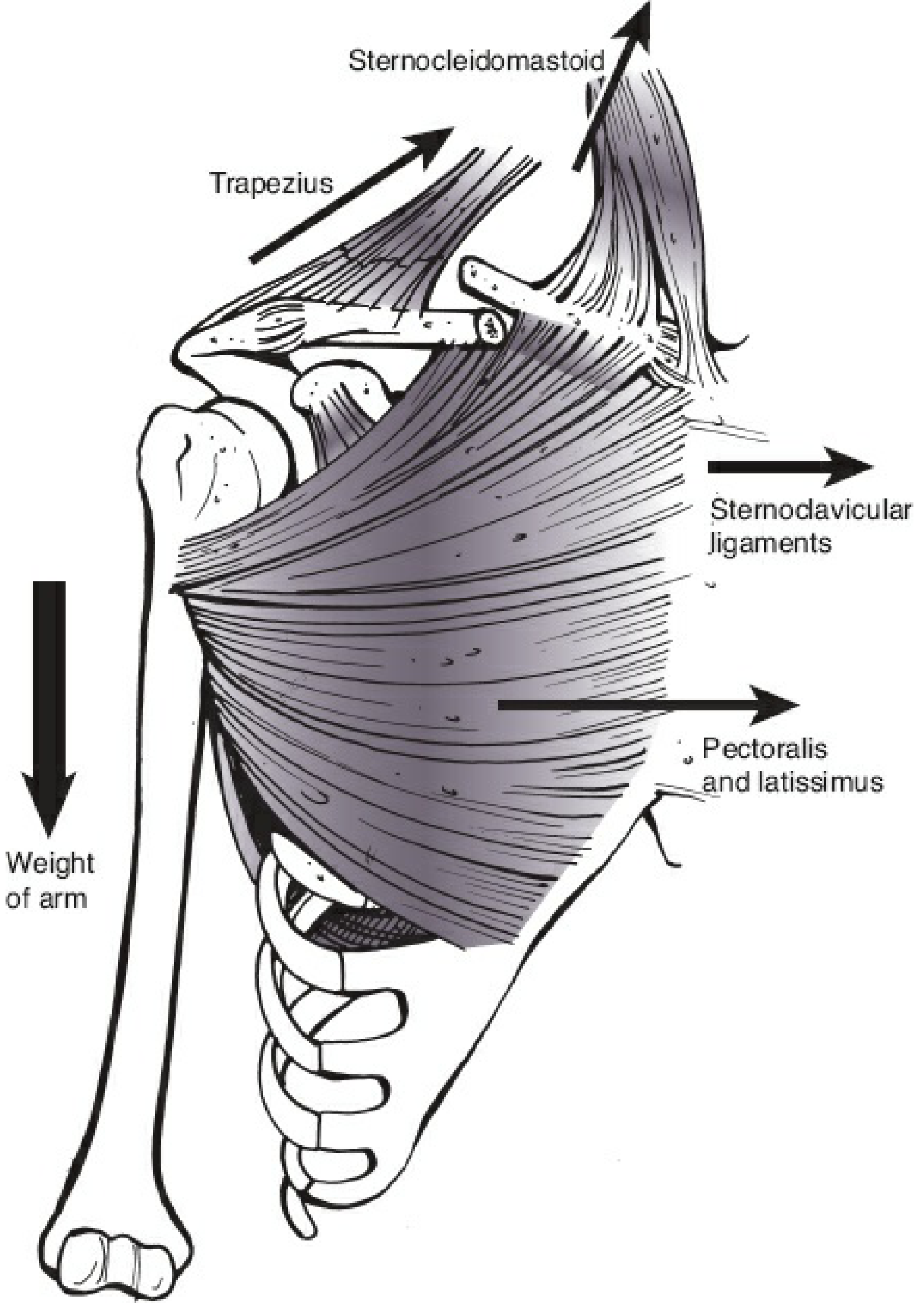 Muscular and gravitational forces acting on a fractured clavicle