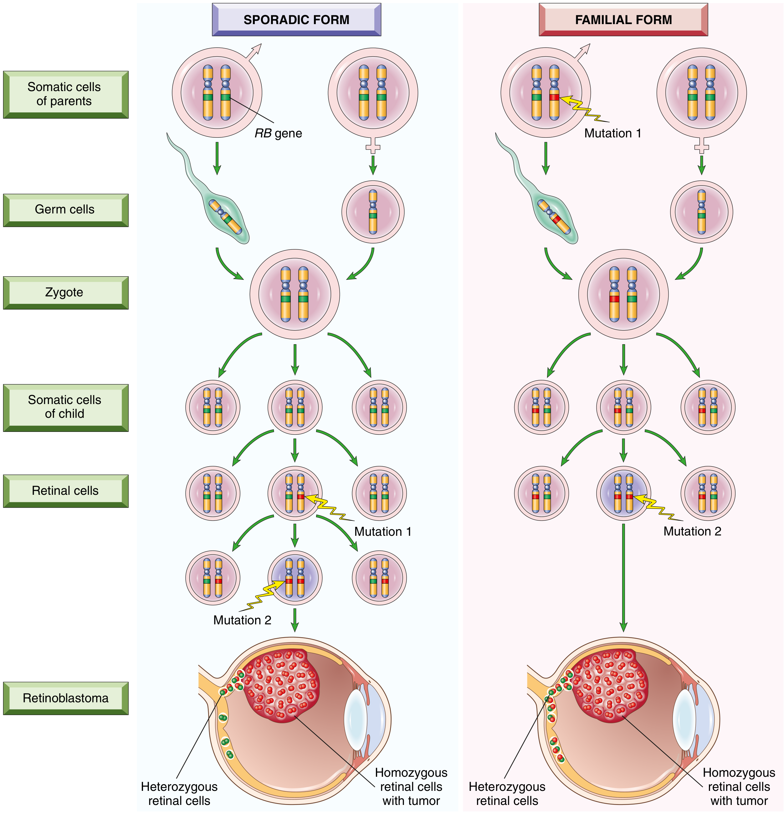Fig. 6.18 / Fig. 7.25 - Pathogenesis of Retinoblastoma showing Sporadic and Familial forms