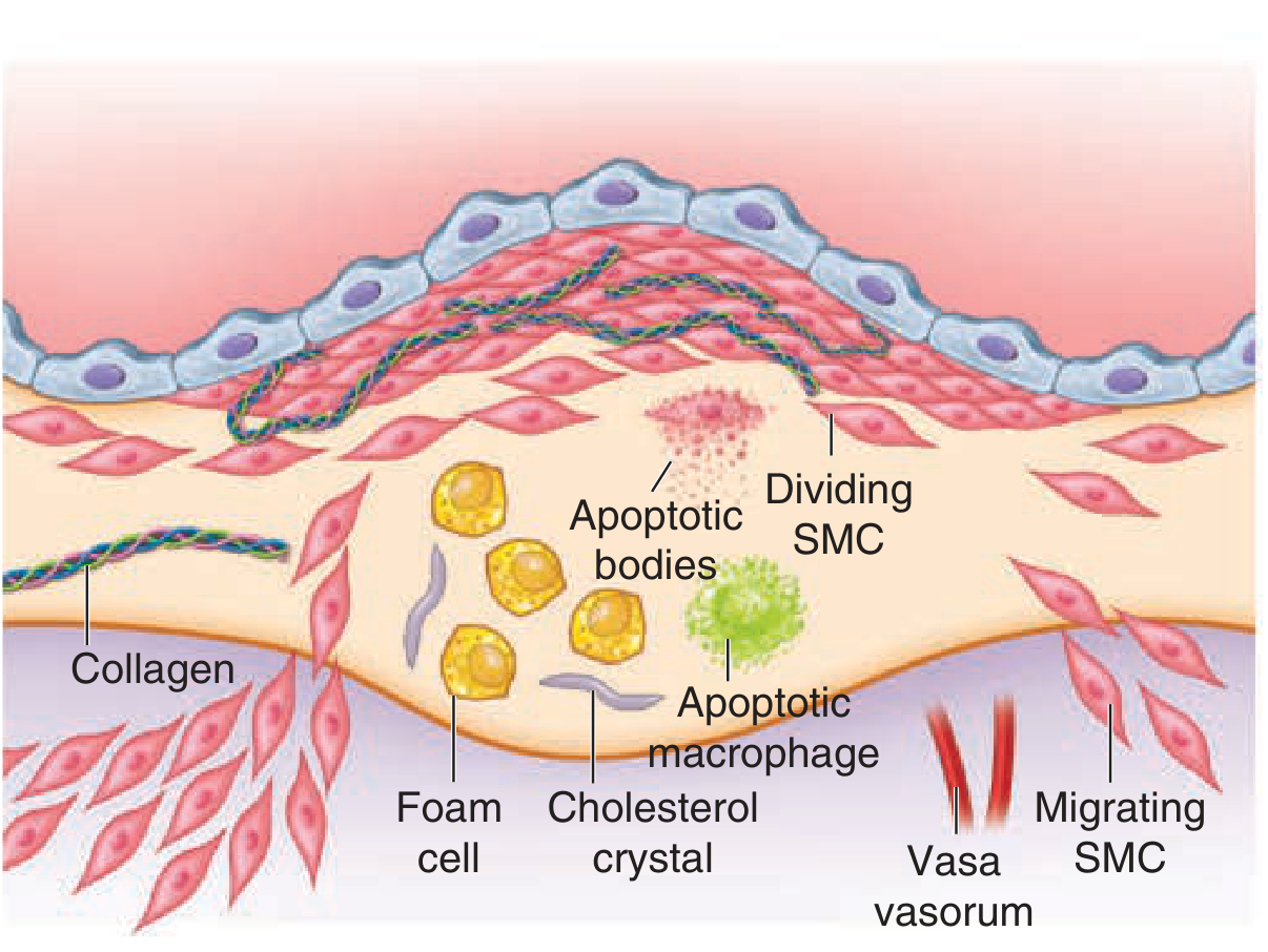 Atherosclerotic plaque diagram showing foam cells alongside cholesterol crystals and smooth muscle cells