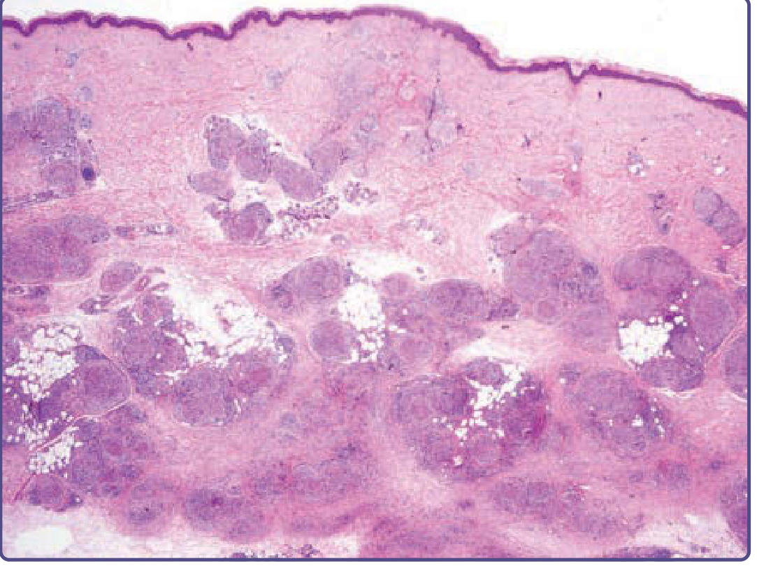 Histology of cutaneous sarcoidosis showing "naked" non-caseating granulomas in the dermis