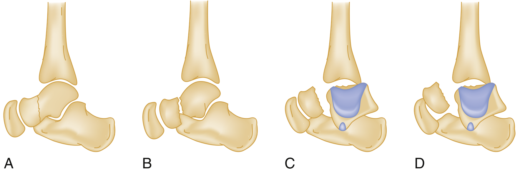 Hawkins Classification of Talar Neck Fractures - Types A, B, C, D