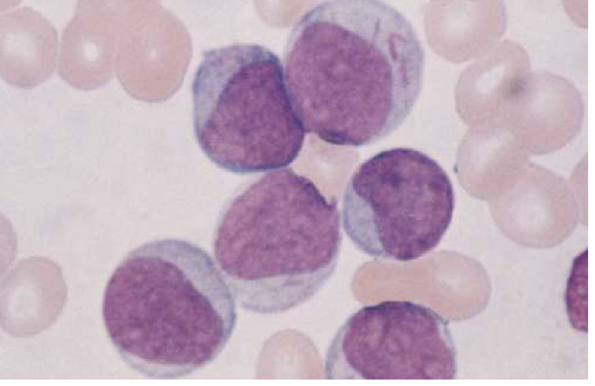 AML - myeloblasts with Auer rods (Goldman-Cecil Medicine)