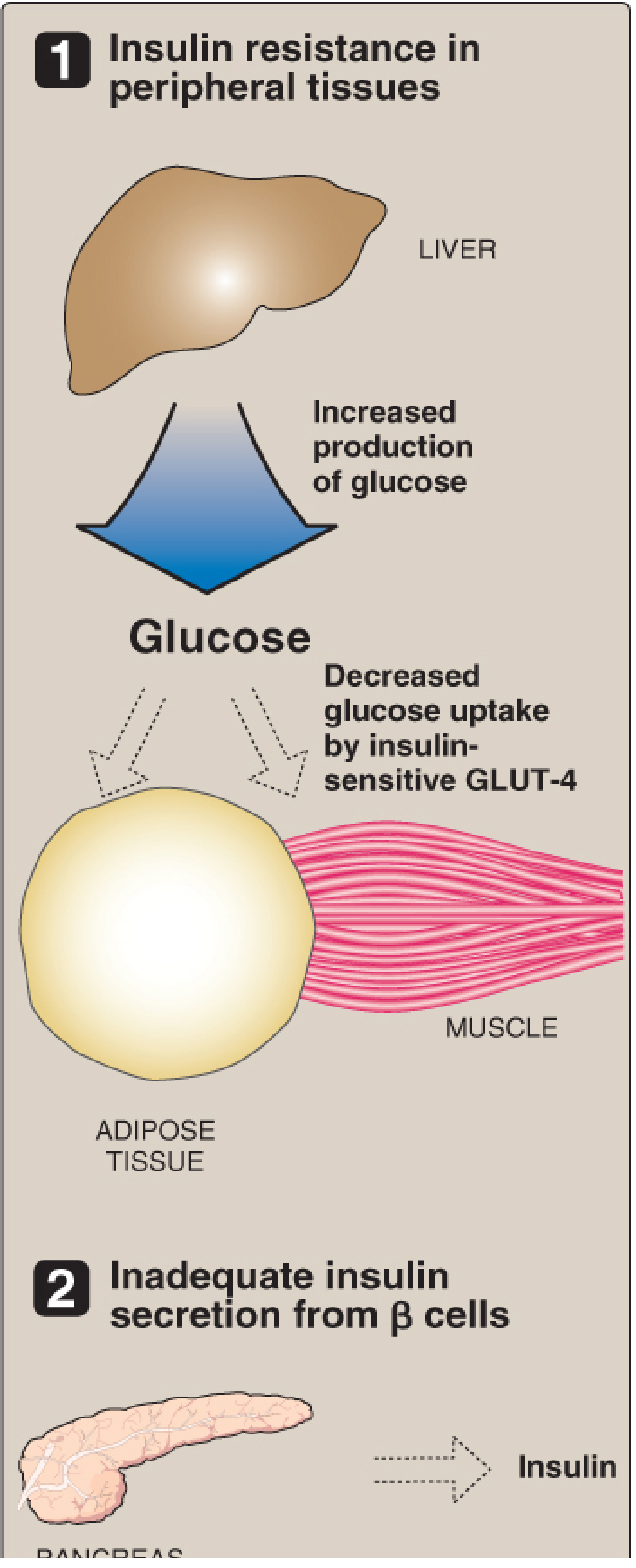 Type 2 Diabetes: Insulin resistance in peripheral tissues and inadequate insulin secretion from beta cells