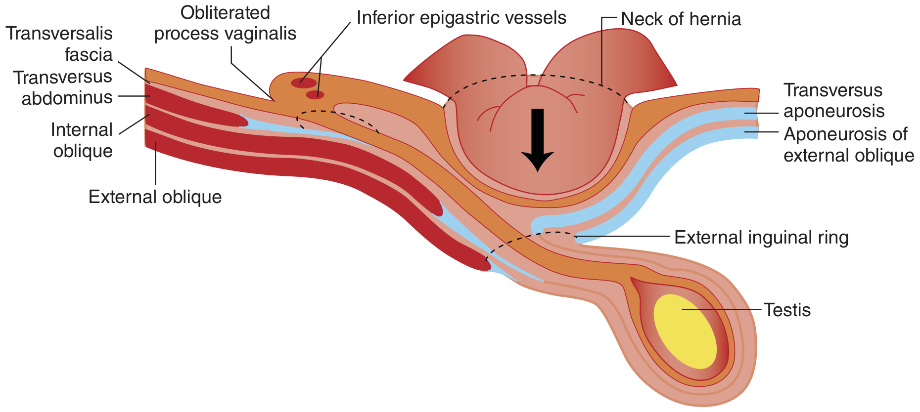 Cross-sectional diagram of direct inguinal hernia showing herniation directly through posterior wall medial to inferior epigastric vessels