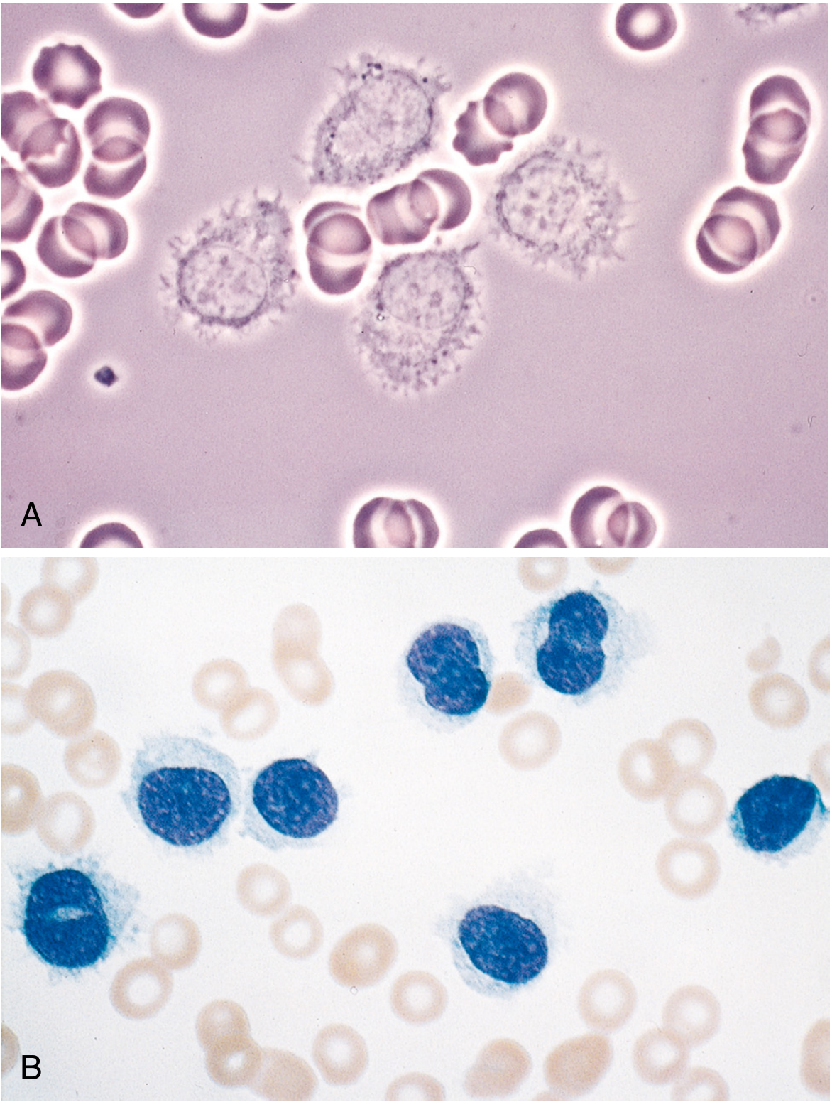 Hairy cell leukemia peripheral blood smear — A: phase contrast showing hair-like projections; B: stained smear showing round/folded nuclei, pale blue cytoplasm with irregular cytoplasmic borders