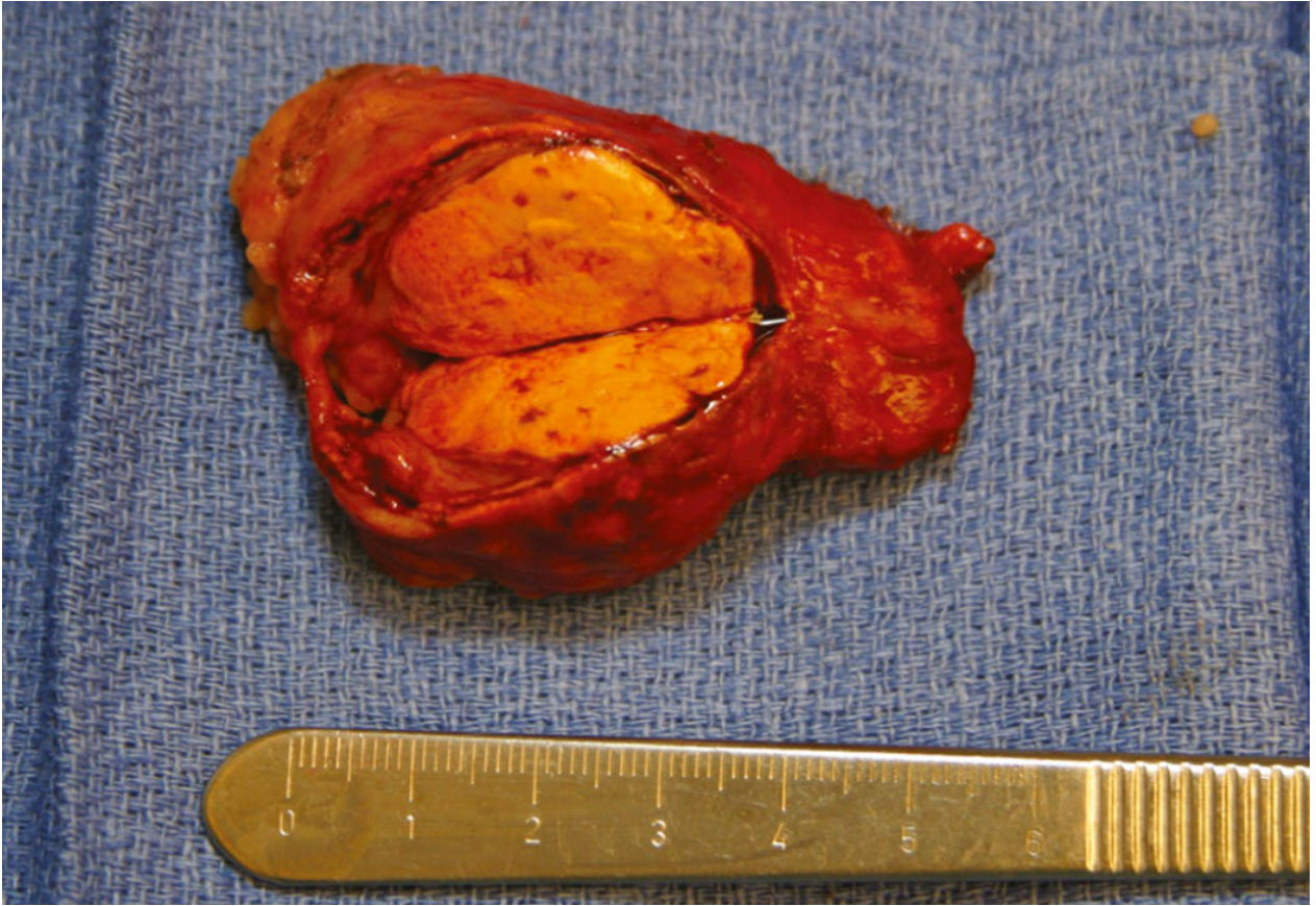 Classic canary-yellow aldosteronoma resected specimen (~5 cm), with characteristic bright yellow cut surface due to high lipid content