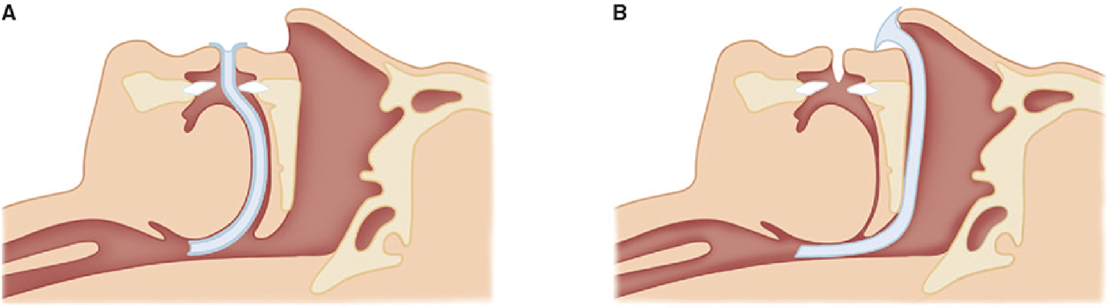 Oropharyngeal airway (A) and Nasopharyngeal airway (B) in situ - both create a patent channel and lift the tongue/epiglottis off the posterior pharyngeal wall