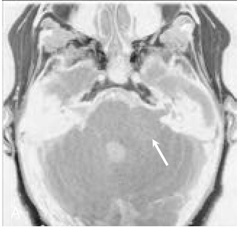 Vestibular Schwannoma - Axial T1 MRI, left CPA