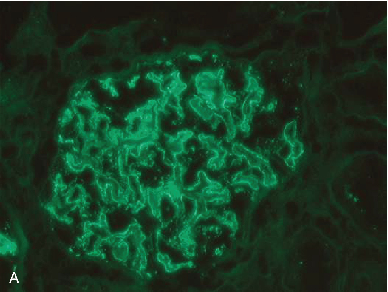 Immunofluorescence microscopy of a glomerulus showing bright granular green capillary wall IgG deposits — membranous glomerulopathy