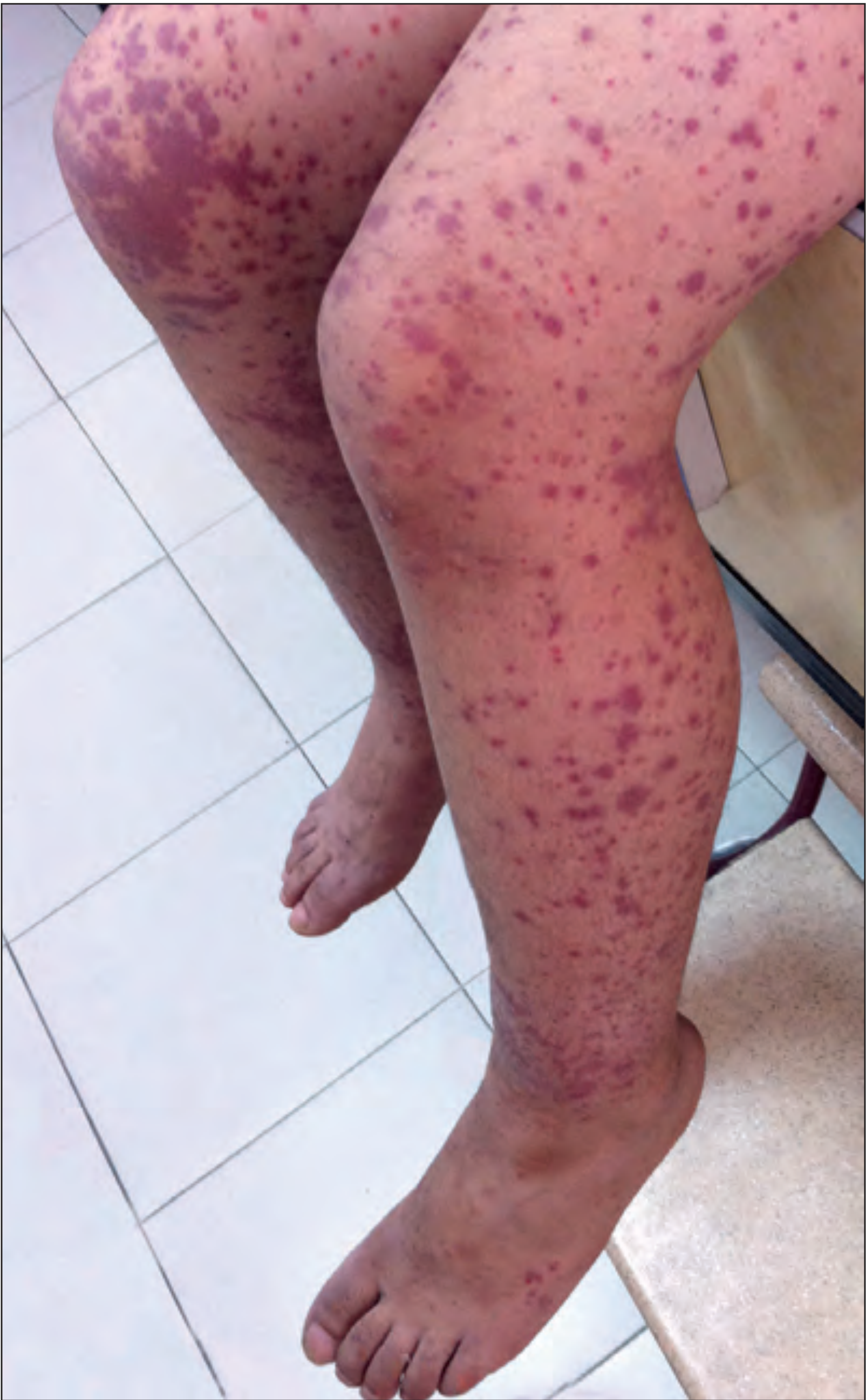 Palpable purpura of lower limbs in HSP/IgA Vasculitis