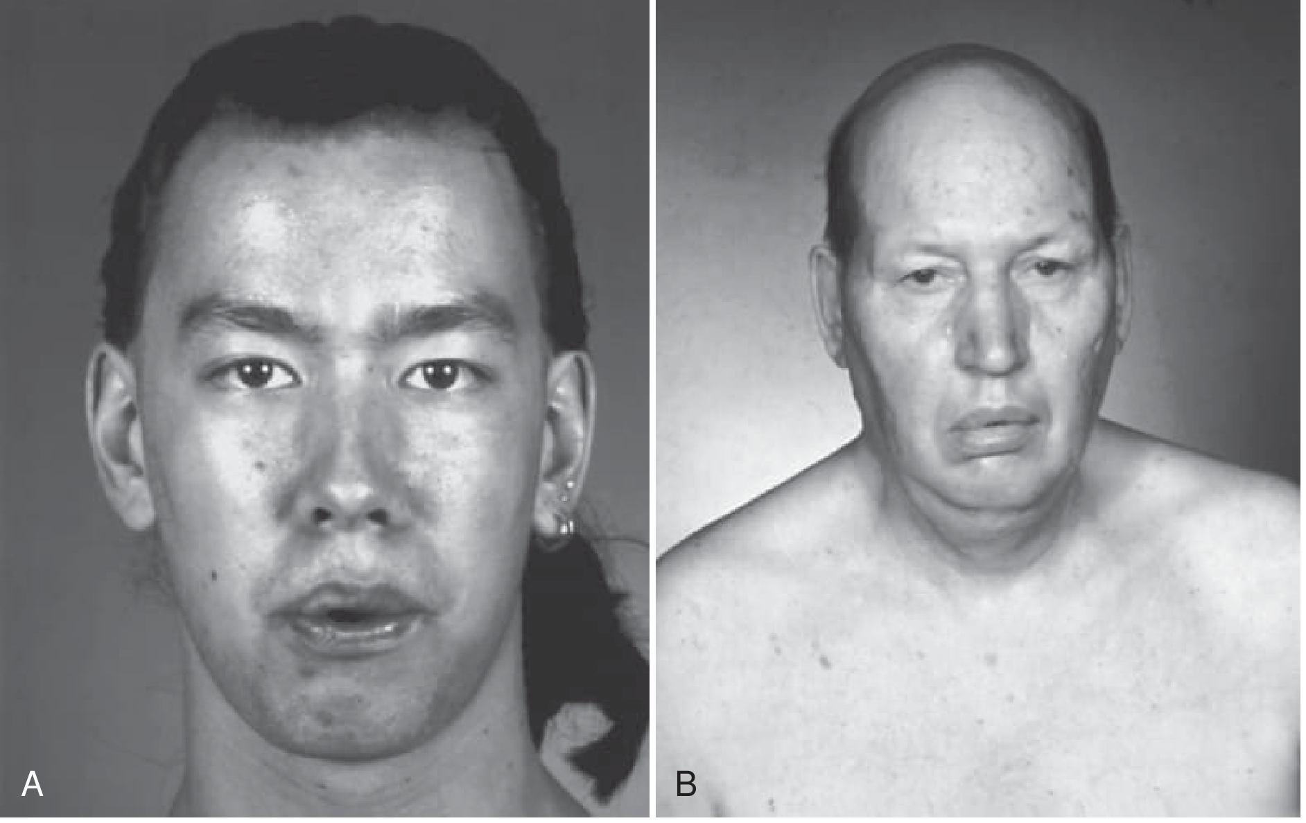 Fig. 28.9 - FSH dystrophy vs Myotonic dystrophy facial comparison