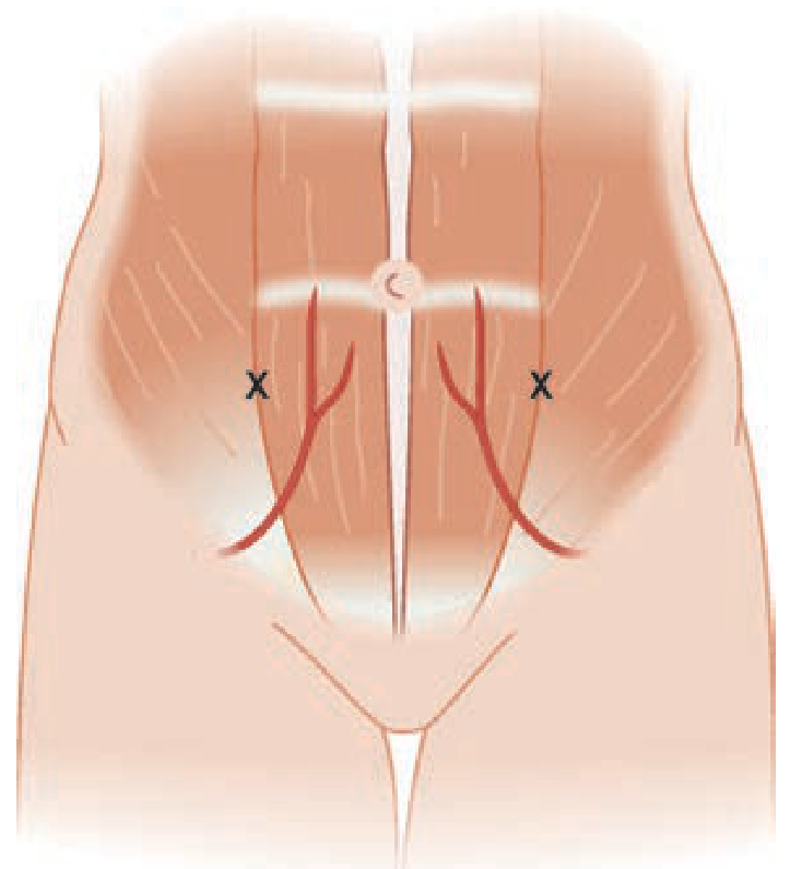 Needle insertion sites (X marks) in the left and right lower quadrants, lateral to the inferior epigastric vessels